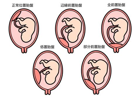 前置胎盤原因|前置胎盤とは？原因や治し方、日常生活の過ごし方、。